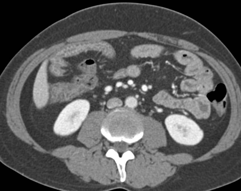 Crohn's Disease - CTisus CT Scan