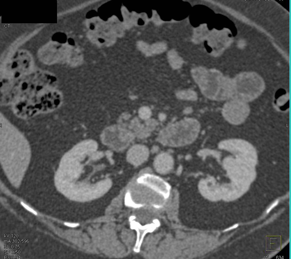 Subtle Adenomatous Polyps in the Duodenum - CTisus CT Scan