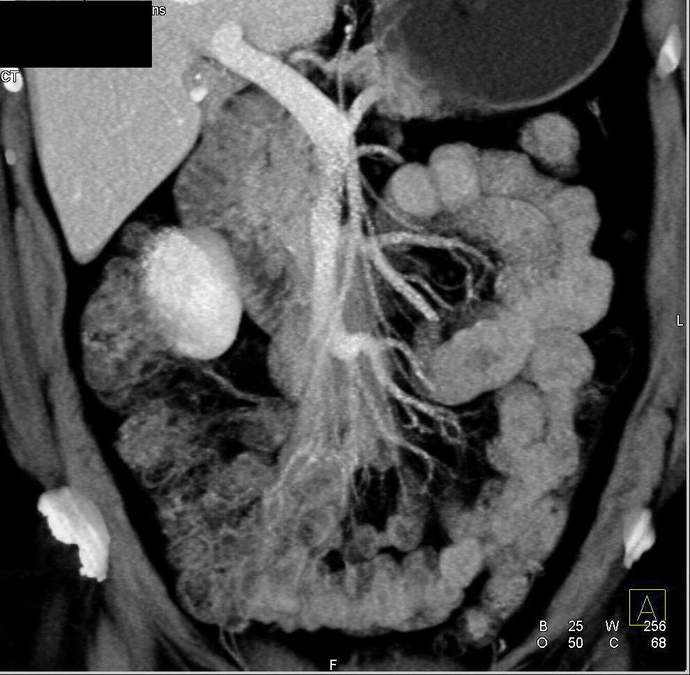 Sclerosing Mesenteritis - CTisus CT Scan