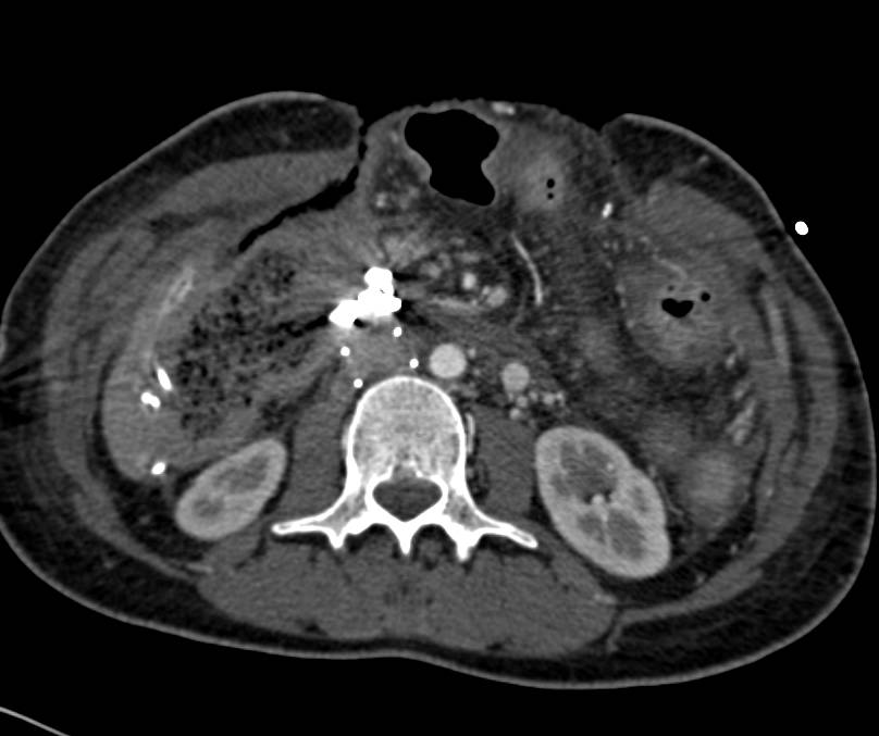 Ischemic Bowel in a Post-Operative Patient - CTisus CT Scan