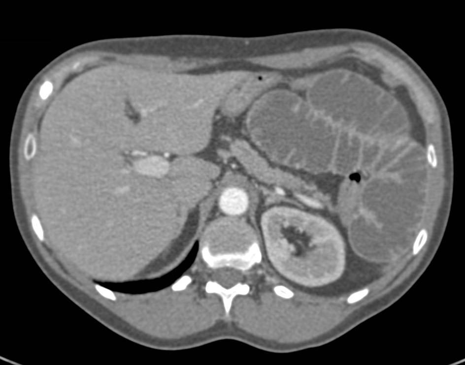 Small Bowel Obstruction (SBO) due to a Midgut Volvulus due to Adhesions - CTisus CT Scan