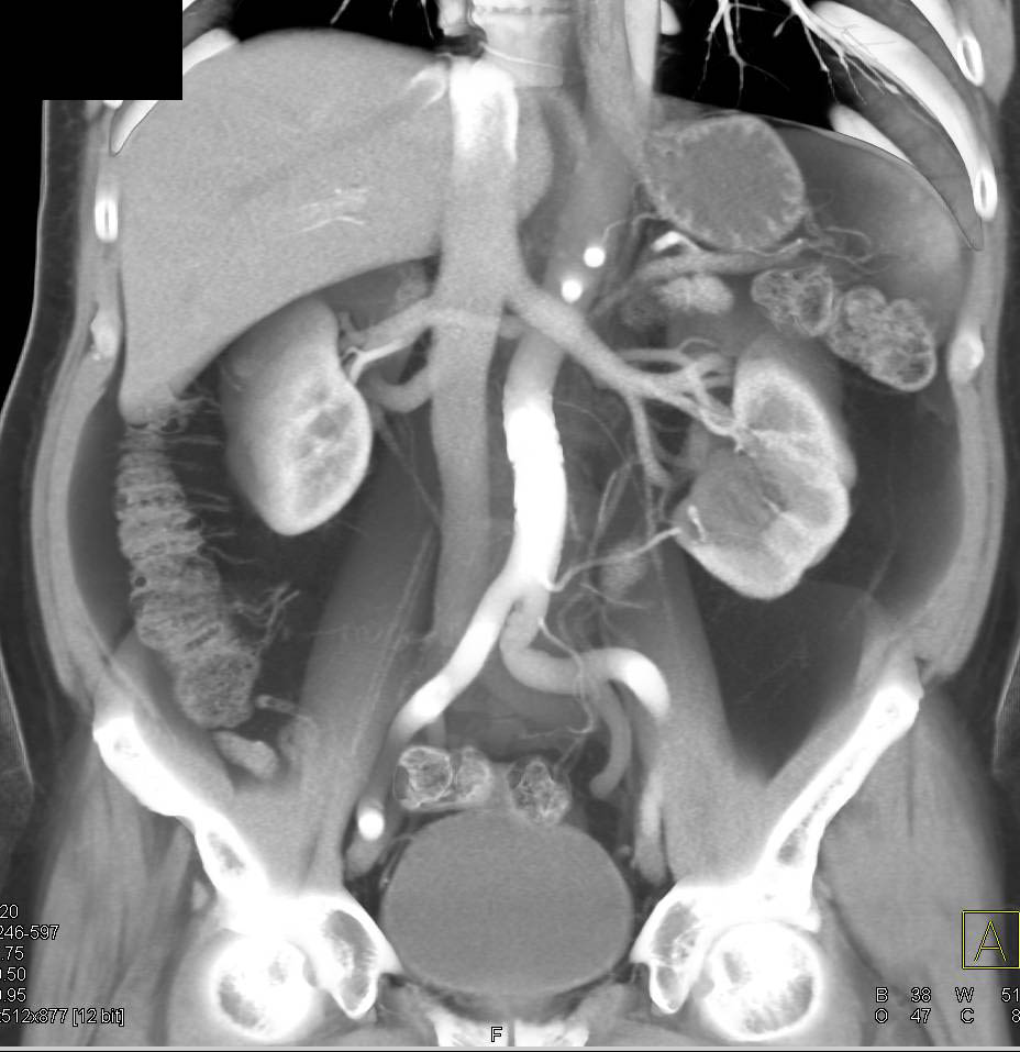 Normal Small Bowel Using Volumen and IV Contrast at 30 minutes - CTisus CT Scan