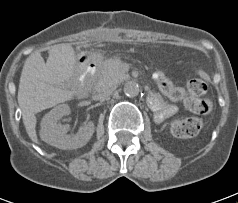 Adenocarcinoma of the Duodenum - CTisus CT Scan