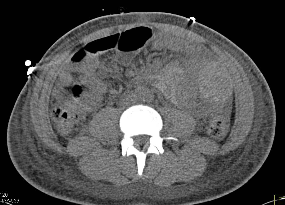 Small Bowel Lymphoma - CTisus CT Scan