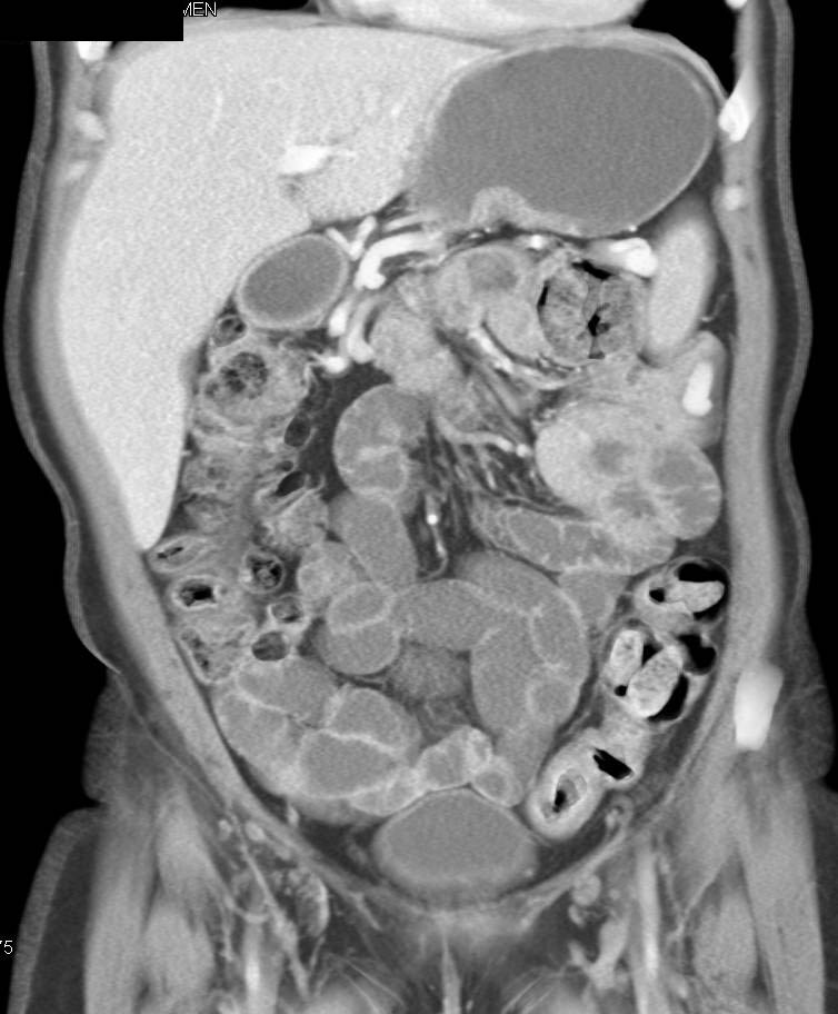 Fluid Filled Small Bowel due to Volumen - CTisus CT Scan