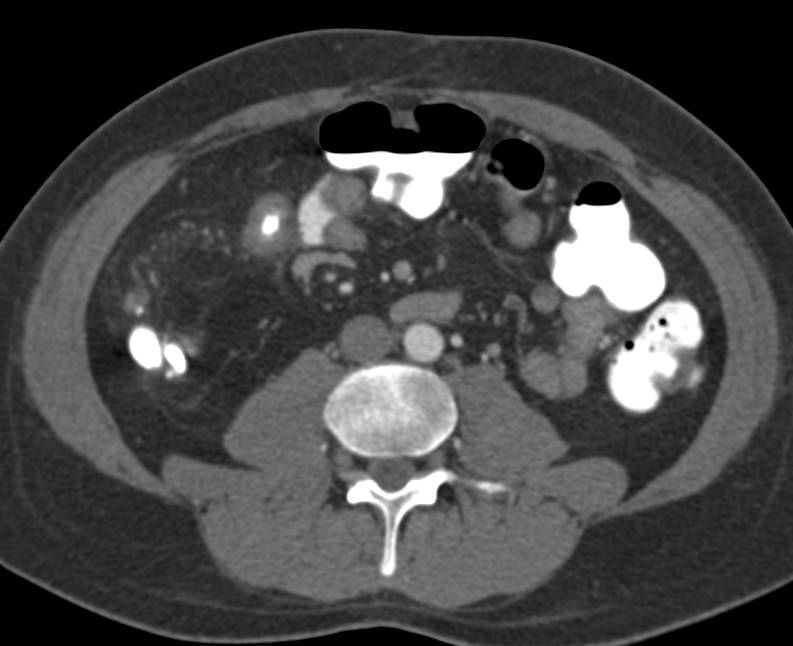 Crohn's Disease with Multiple Structures - CTisus CT Scan