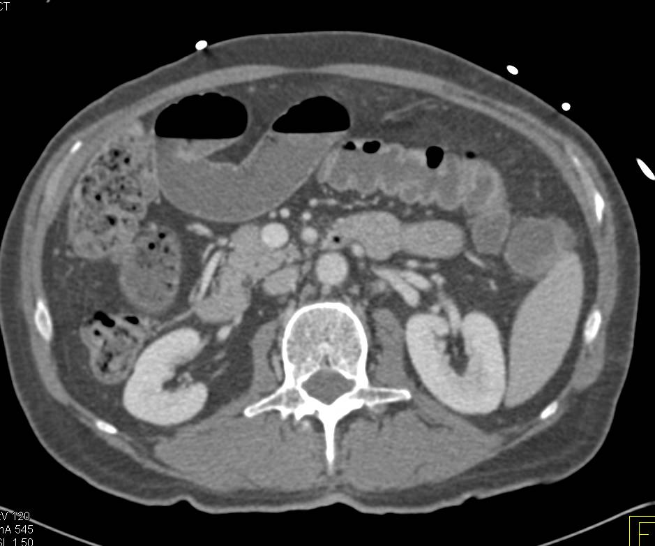 Small Bowel Obstruction (SBO) due to an Incarcerated Right Inguinal Hernia - CTisus CT Scan