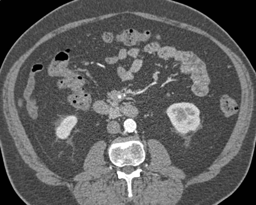 Carcinoid Tumor in the Root of the Mesentery Which is Partially Calcified and Has a Desmoplastic Reaction - CTisus CT Scan