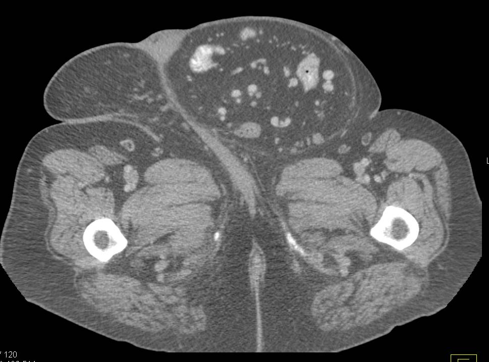 Large Hernia of Small Bowel into the Scrotum - CTisus CT Scan