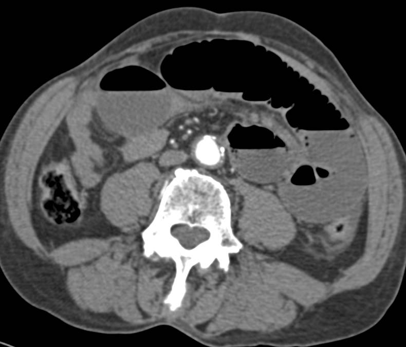 Ischemia with Volvulus of Small Bowel - CTisus CT Scan