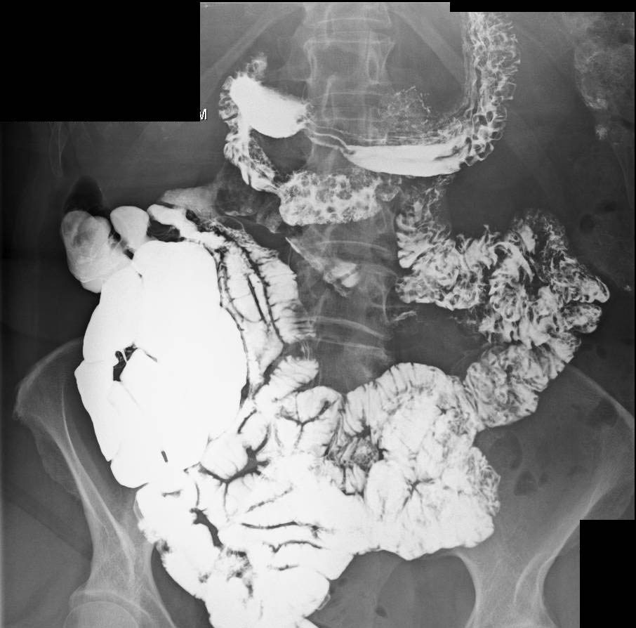 Duodenal Polyps in a Patient with Polyposis Syndrome - CTisus CT Scan