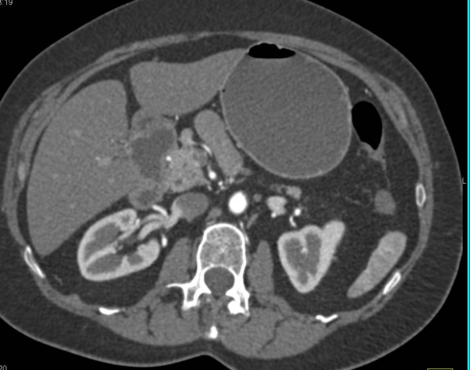 Multiple Polypoid Duodenal Masses due to Adenomatous Polyps with Superimposed Carcinoma - CTisus CT Scan