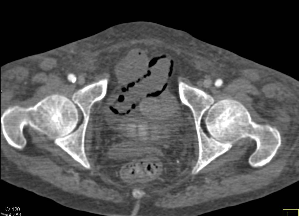 Ischemic Small Bowel due to Low Flow State. Pneumatosis of Small Bowel Nicely Seen - CTisus CT Scan