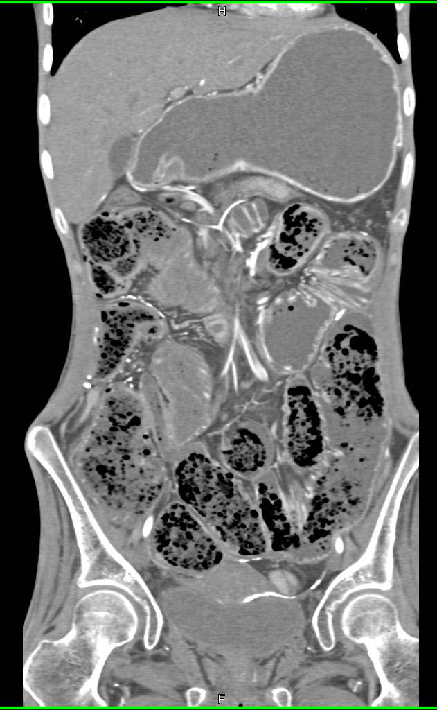 Dilated Small Bowel with Obstruction in a Patient with Prior Bowel Perforation with Barium in Peritoneal Cavity - CTisus CT Scan