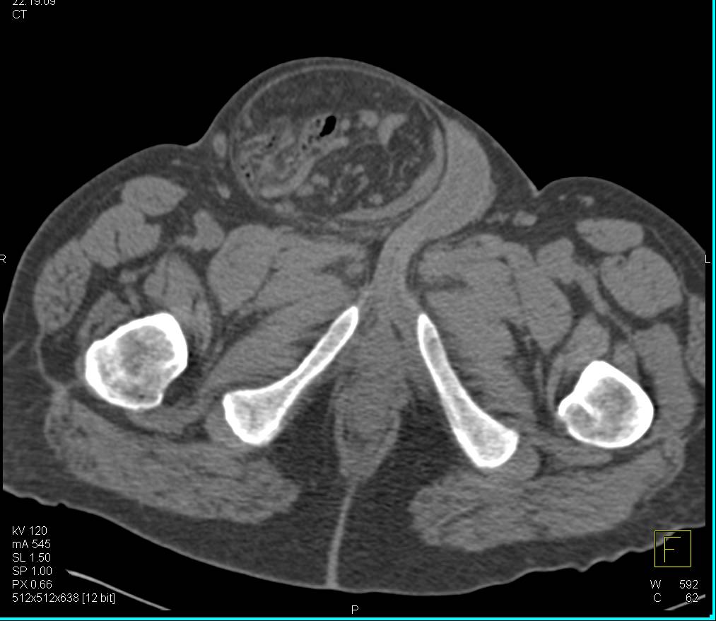 Small Bowel Obstruction due to Herniation of Bowel Through an Inguinal Hernia into the Scrotum - CTisus CT Scan