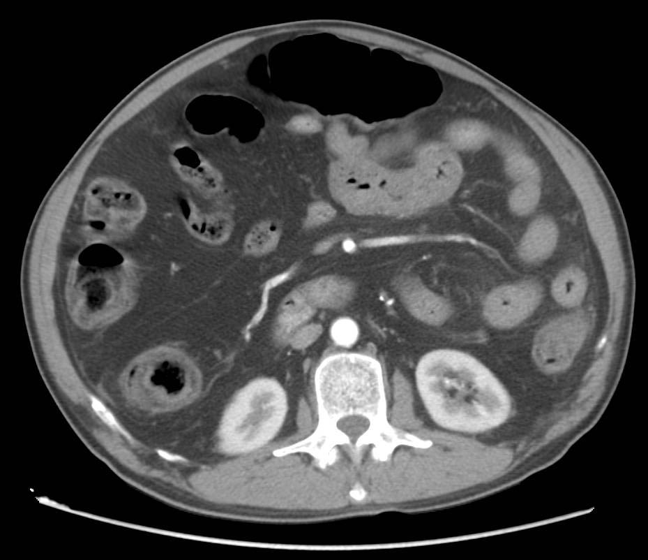 Thickened Small Bowel as a Complication of a Bone Marrow Transplant;  GVH (graft vs host disease) - CTisus CT Scan