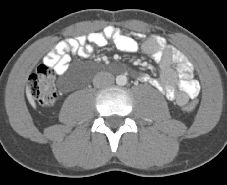 Lymphangioma in the Root of the Mesentery - CTisus CT Scan