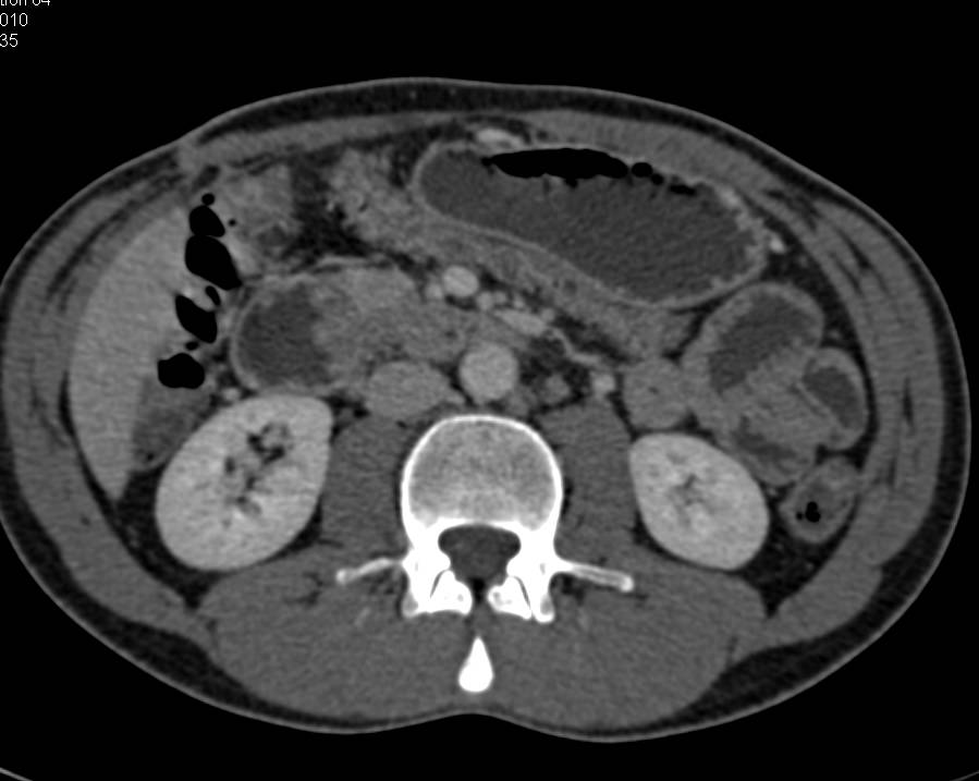 Duodenal Adenocarcinoma in 3rd Portion of the Duodenum - CTisus CT Scan