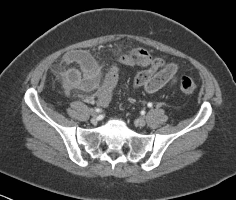 Acute Appendicitis - CTisus CT Scan