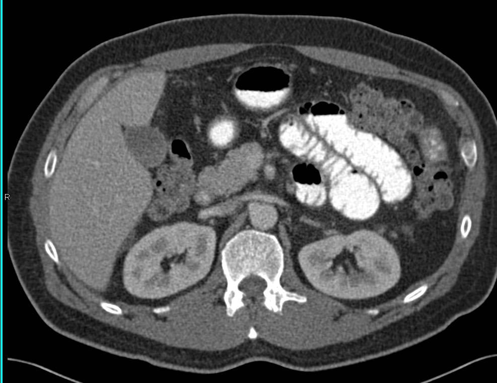 Crohn's Disease with Long Segment Stricture in Bowel - CTisus CT Scan