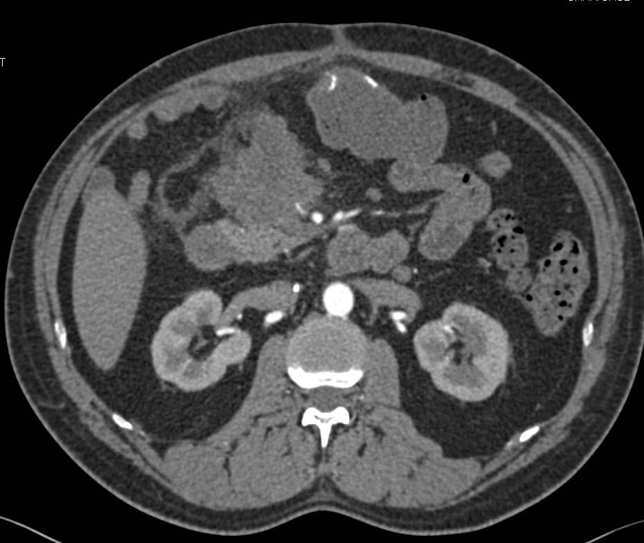 Duodenal Adenocarcinoma in 2nd Portion of the Duodenum - CTisus CT Scan