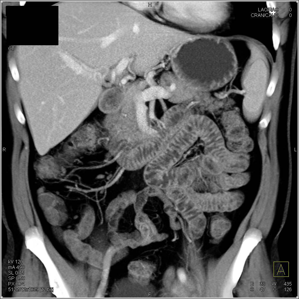 Mildly Dilated Jejunum - CTisus CT Scan