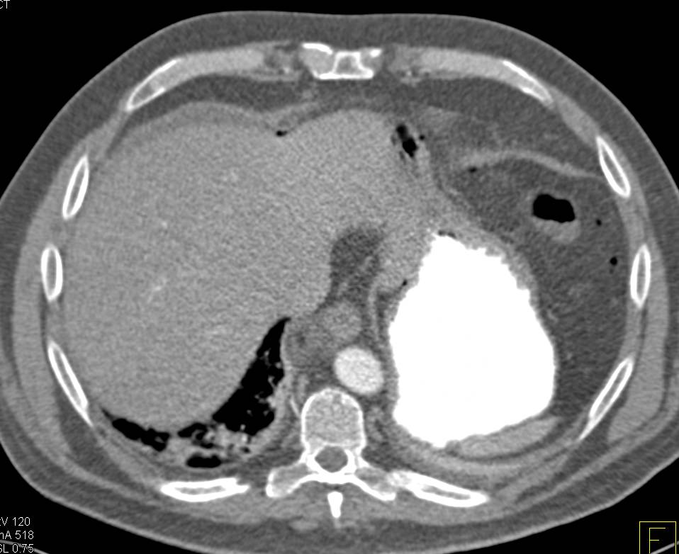 Crohn's Disease with Partial Small Bowel Obstruction (SBO) - CTisus CT Scan