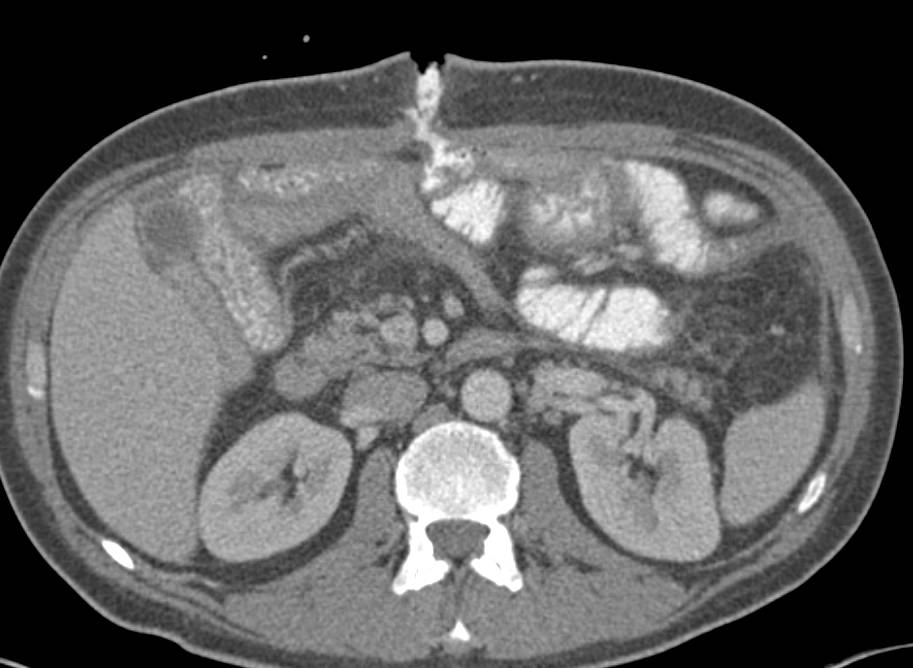 Excellent Visualization of an Enterocutaneous Fistulae (ECF) - CTisus CT Scan