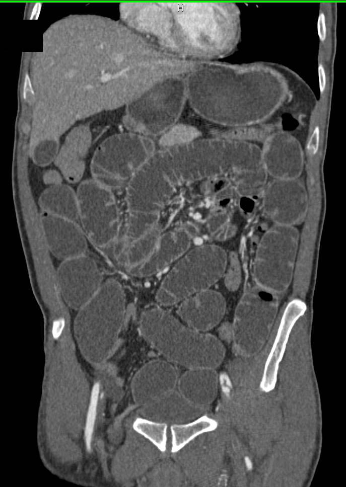 Beautiful Example of Small Bowel Obstruction (SBO) due to a Right Inguinal Hernia - CTisus CT Scan