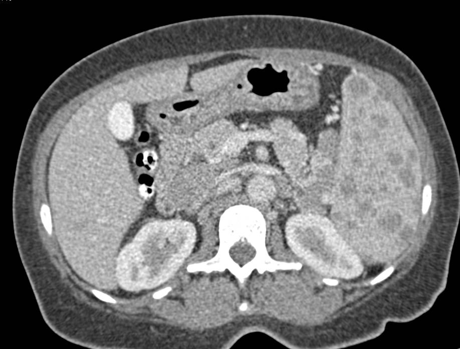 Lymphoma Infiltrates the Spleen and Extensive Adenopathy - CTisus CT Scan