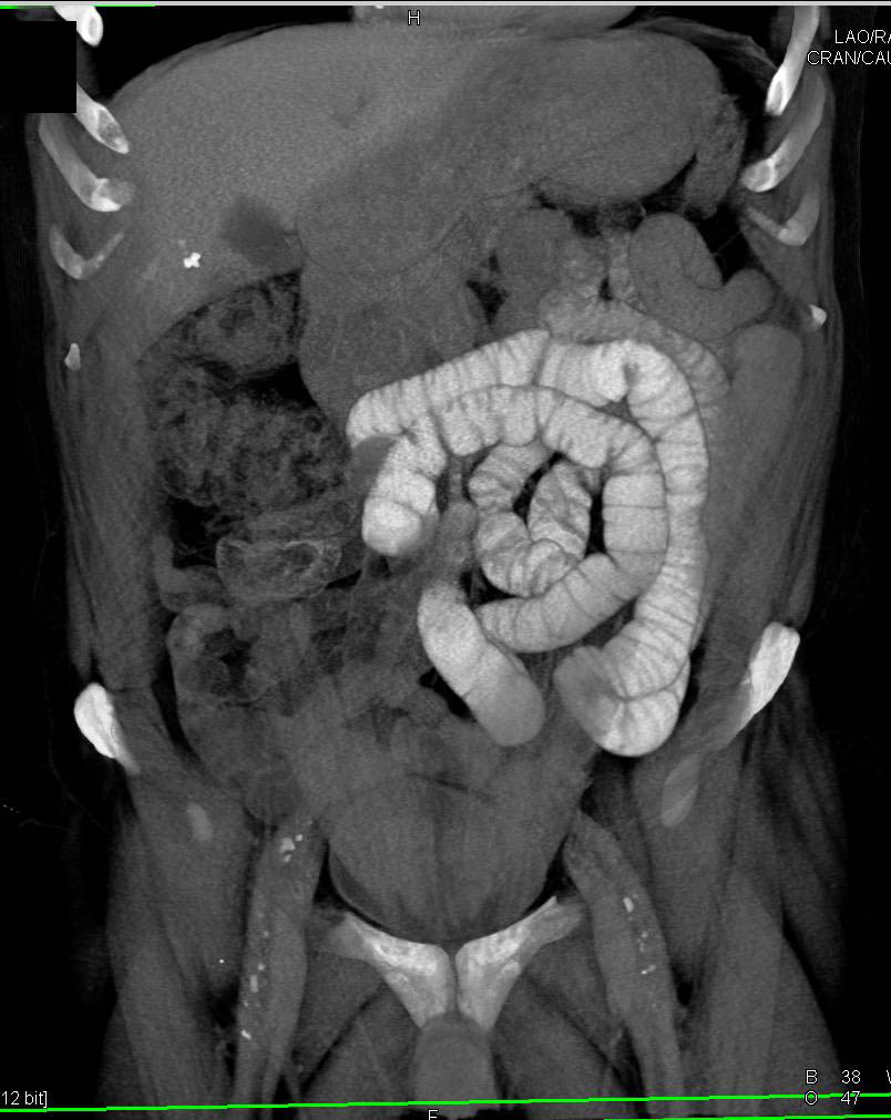 3D VRT of Normal Small Bowel - CTisus CT Scan