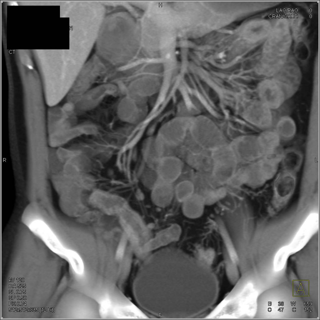 Crohn's Disease with Inflamed Terminal Ileum - CTisus CT Scan