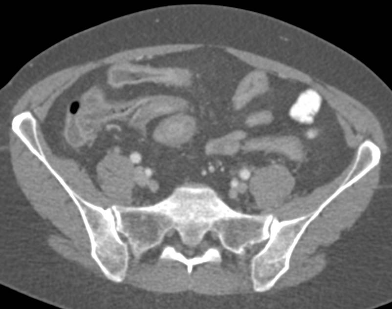 Crohn's Disease of the Distal Small Bowel - CTisus CT Scan