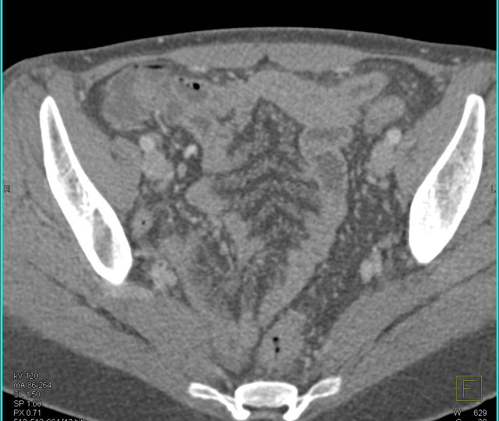 Thickened Mesentery Compatible with Carcinomatosis - CTisus CT Scan