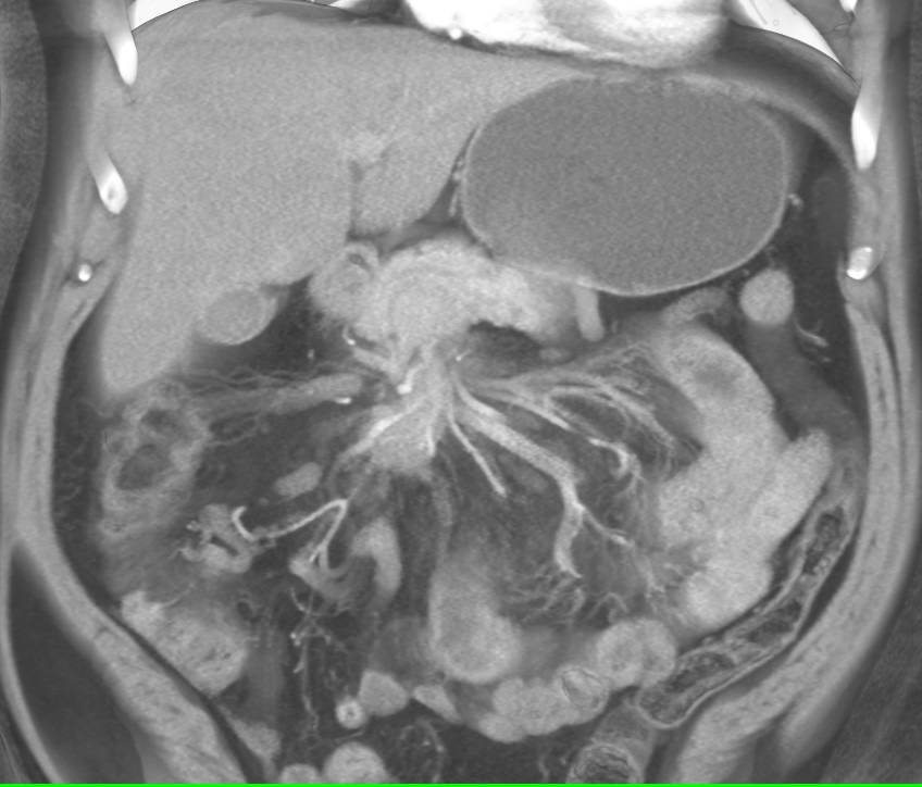 Sclerosing Mesenteritis Simulates a Carcinoid Tumor with Desmoplastic Reaction - CTisus CT Scan