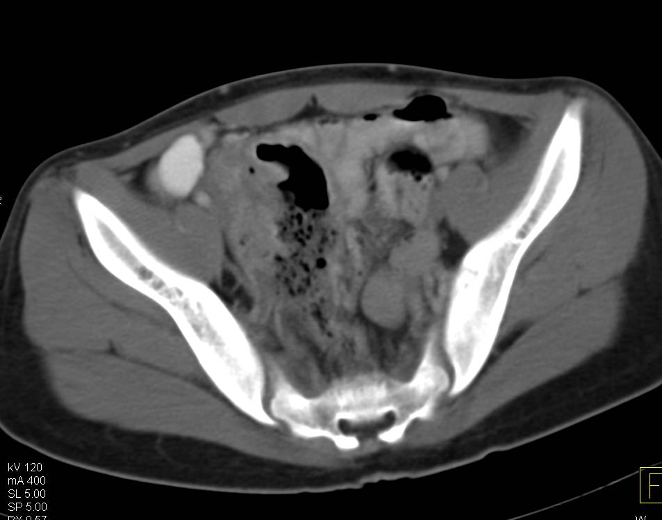 Crohn's Disease with Thickened Bowel - CTisus CT Scan