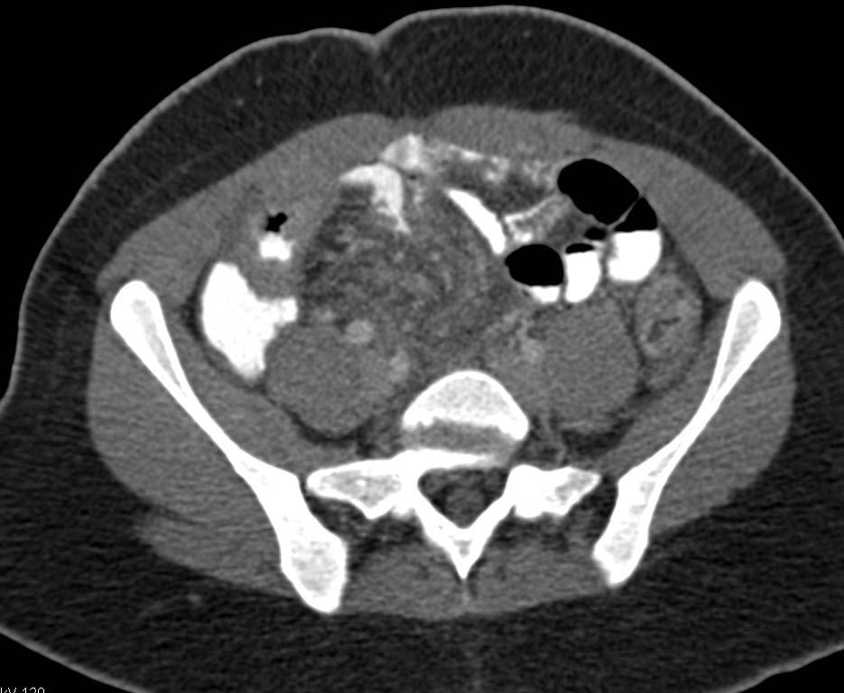 Crohn's Disease with Right Lower Quadrant Abscess - CTisus CT Scan