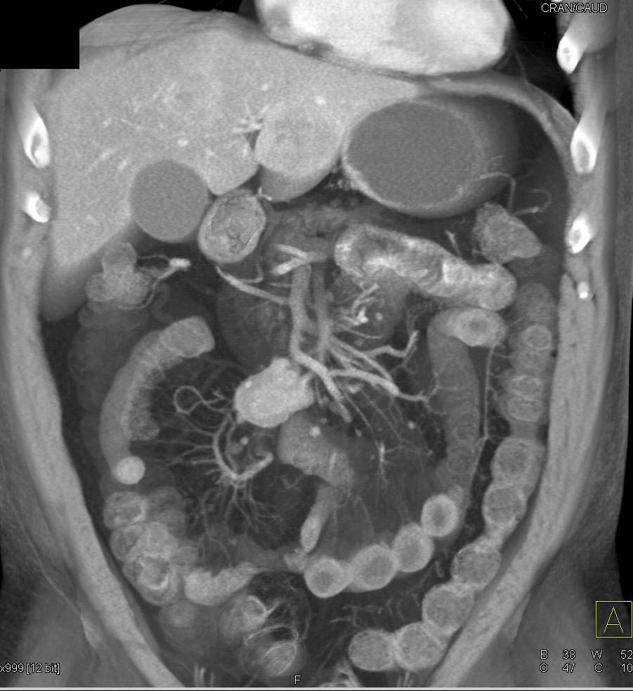 Carcinoid Tumor in the Mesentery - CTisus CT Scan