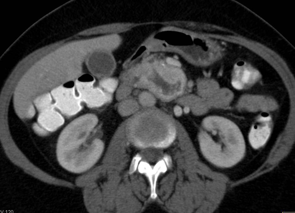 Duodenal Adenocarcinoma in 4th Portion of the Duodenum - CTisus CT Scan