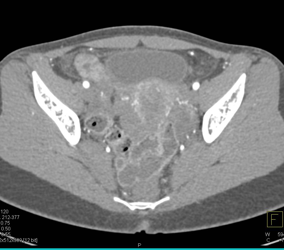 Crohn's with Active Disease in Terminal Ileum and Cecum - CTisus CT Scan