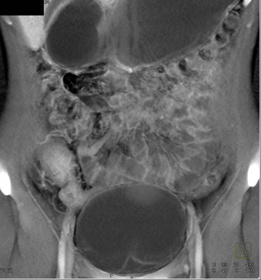 Crohns With Active Disease In Terminal Ileum And Cecum Small Bowel