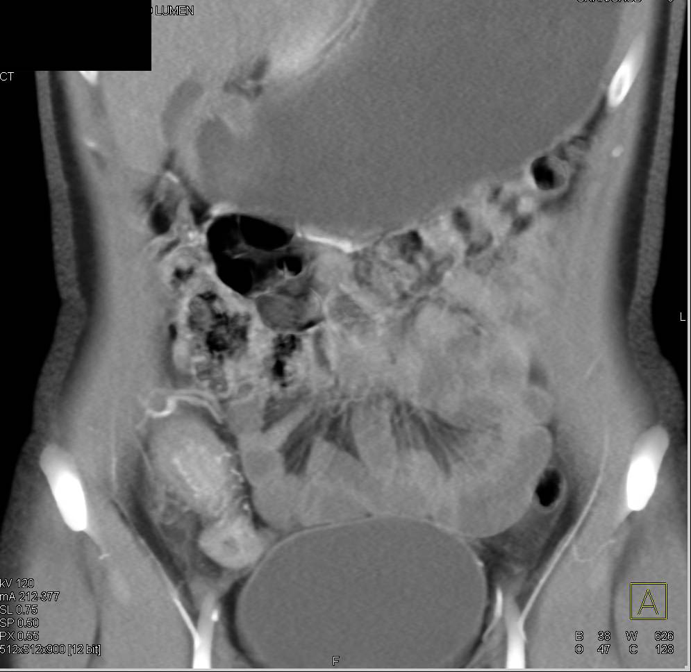 Crohn's Disease with Enhancement of the Distal Ileum - CTisus CT Scan