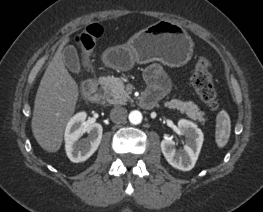 Adenocarcinoma of the 2nd Portion of the Duodenum - CTisus CT Scan