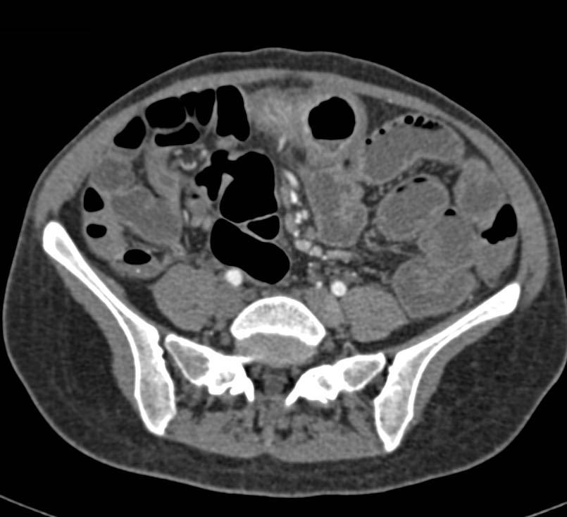 Crohn's Disease with Increased Bowel Enhancement and Stricture - CTisus CT Scan