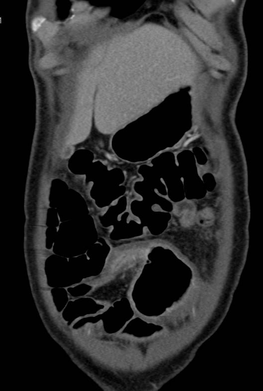 Crohn's Disease of the Distal Small Bowel - CTisus CT Scan