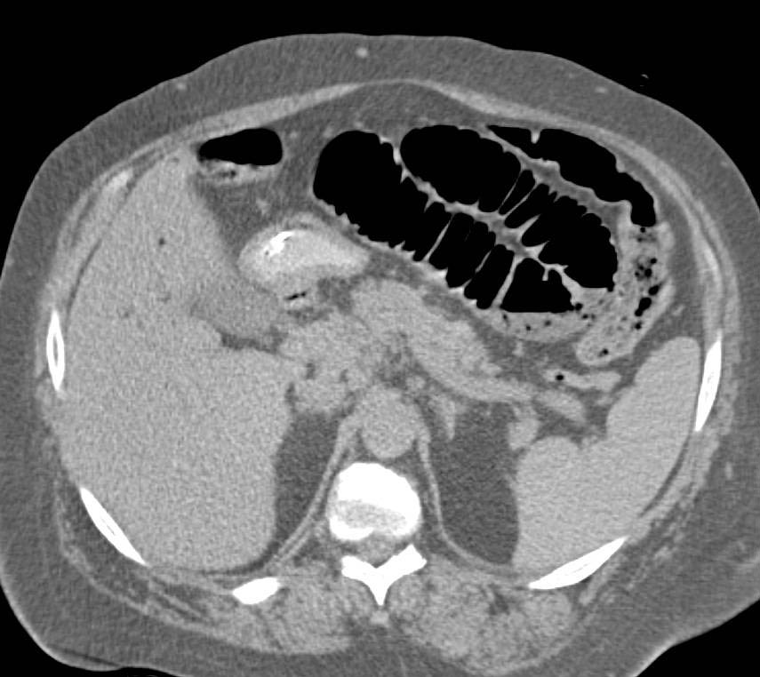 Ischemic Bowel with Portal Venous Air and Small Bowel Pneumatosis Nicely Shown in 3D - CTisus CT Scan