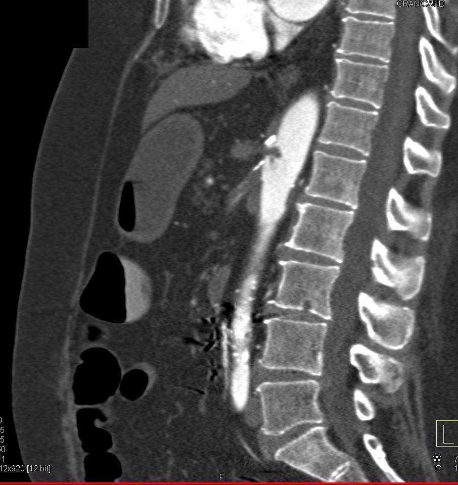 Clot in Superior Mesenteric Artery (SMA) and Celiac Leads to Ischemic Bowel - CTisus CT Scan
