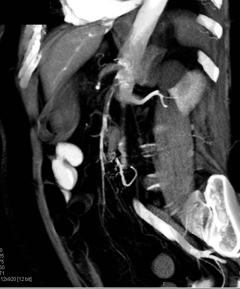 Celiac and Superior Mesenteric Artery (SMA) Occlusion with Ischemic Bowel - CTisus CT Scan