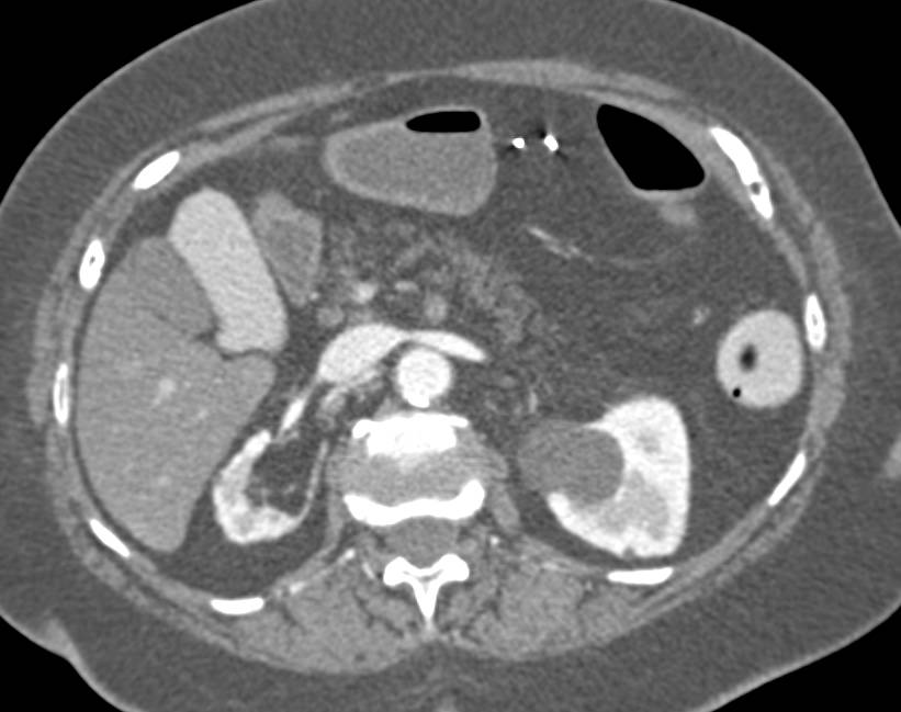 Superior Mesenteric Artery (SMA) Occlusion with Early Ischemic Bowel - CTisus CT Scan