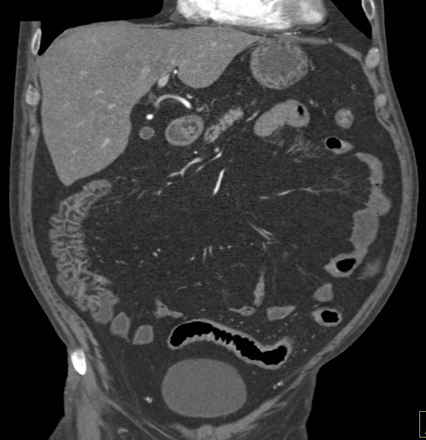 Beautiful 3D CTA Display of Crohn's Disease Involving Large and Small Bowel - CTisus CT Scan